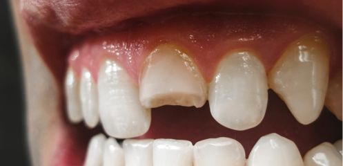 Cracked or broken tooth